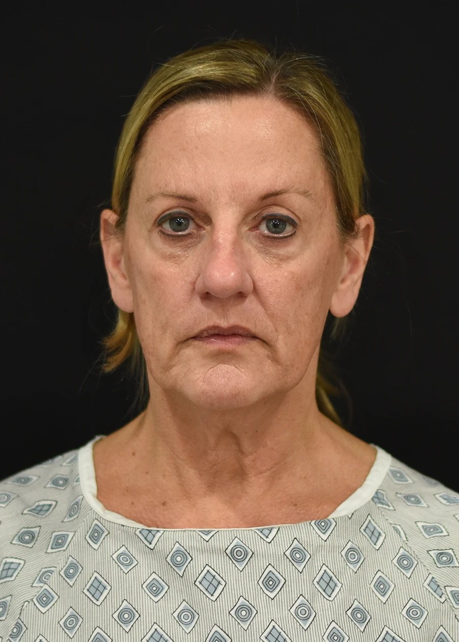 Extended Deep Plane Facelift Patient 9 Set 1 Before