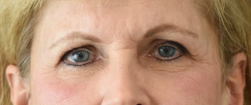 Brow Lift Patient 4 Set 1 Before